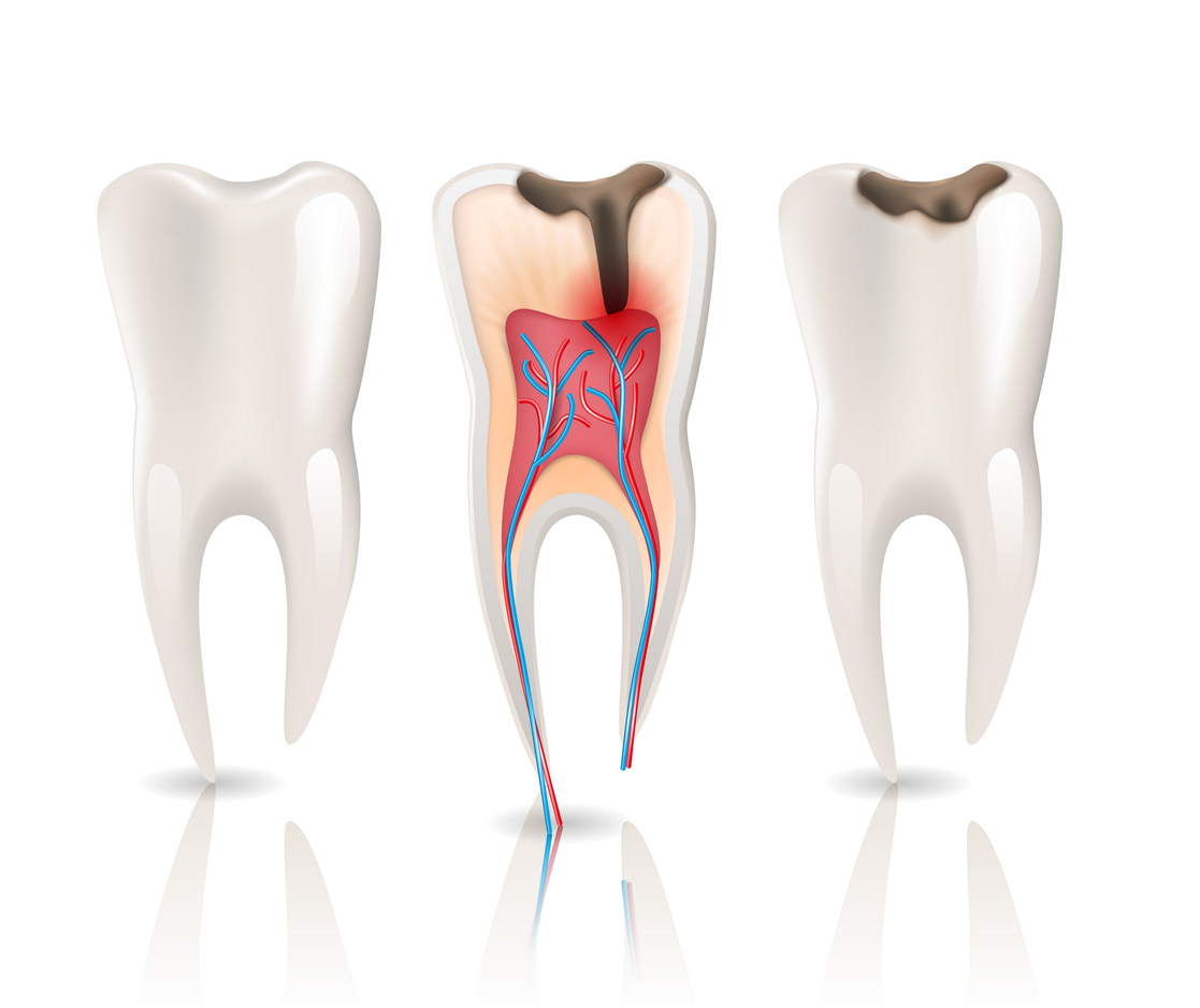 Caries and Health Tooth 3d Realistic Pulpitis.