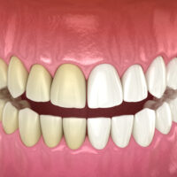 Teeth,Whitening,-,Before,And,After.,Dental,Concept,,3d,Illustration