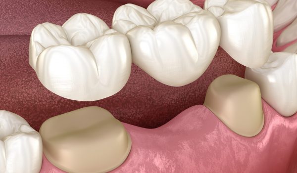 Dental bridge of 3 teeth over molar and premolar. Medically accurate 3D illustration of human teeth treatment
